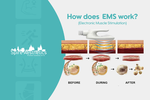 EMS treatment for post pregnancy weight loss treatment Hythe