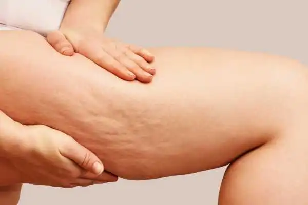Image of woman showing leg with cellulite Hythe