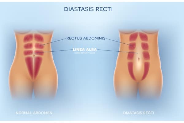 What Non-Surgical Options Are Available for Diastasis Recti Hythe?