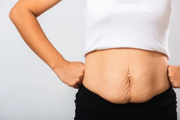 Image of a woman's stomach after weight loss with sagging skin following a gastric band Hythe