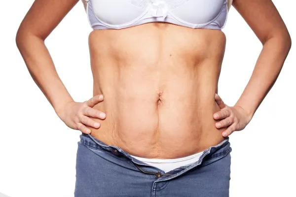 sagging skin on woman's stomach after weight loss injections Hythe