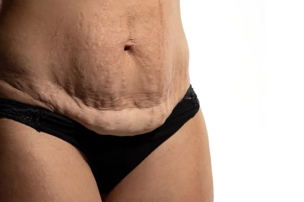 Image of womans stomach after weight loss injections Hythe showing saggy skin