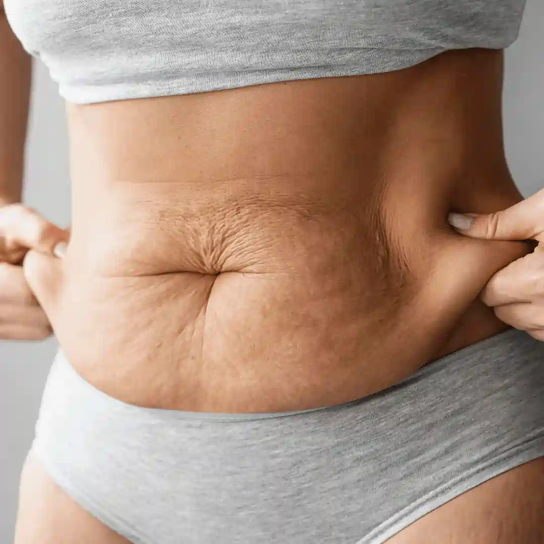 Is It Normal to Have Loose Skin After Pregnancy Hythe?
