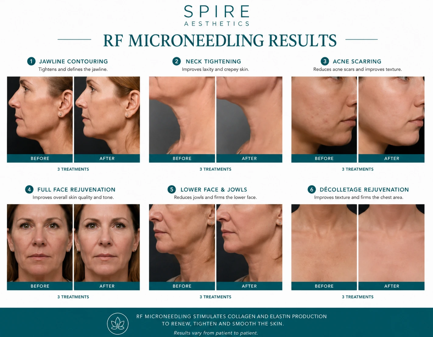 RF Microneedling Skin tightening Hythe results