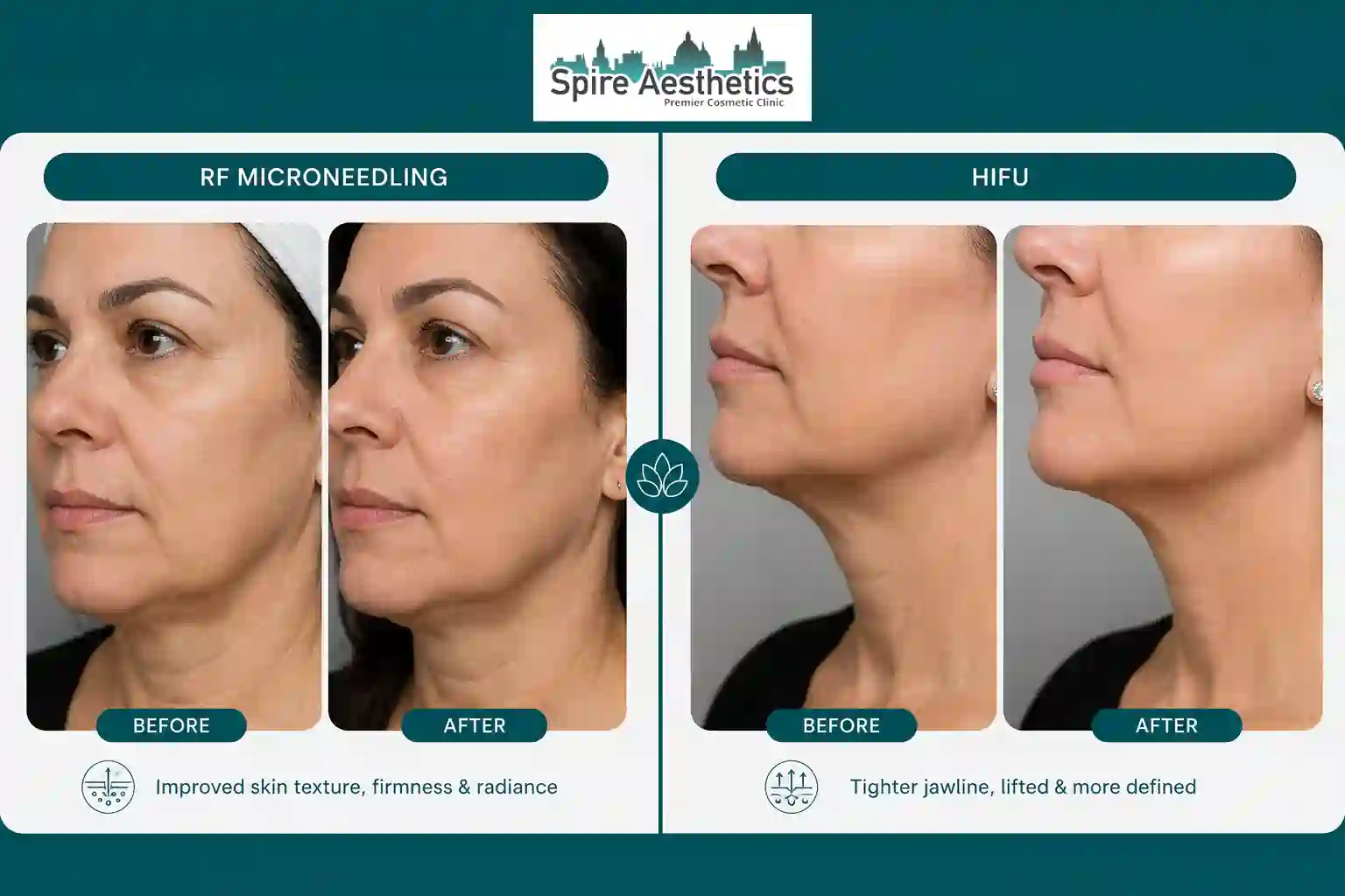 Can RF Microneedling and HIFU Be Combined Hythe?