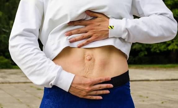 When Could Diastasis Recti Be the Missing Piece of the Puzzle Hythe?