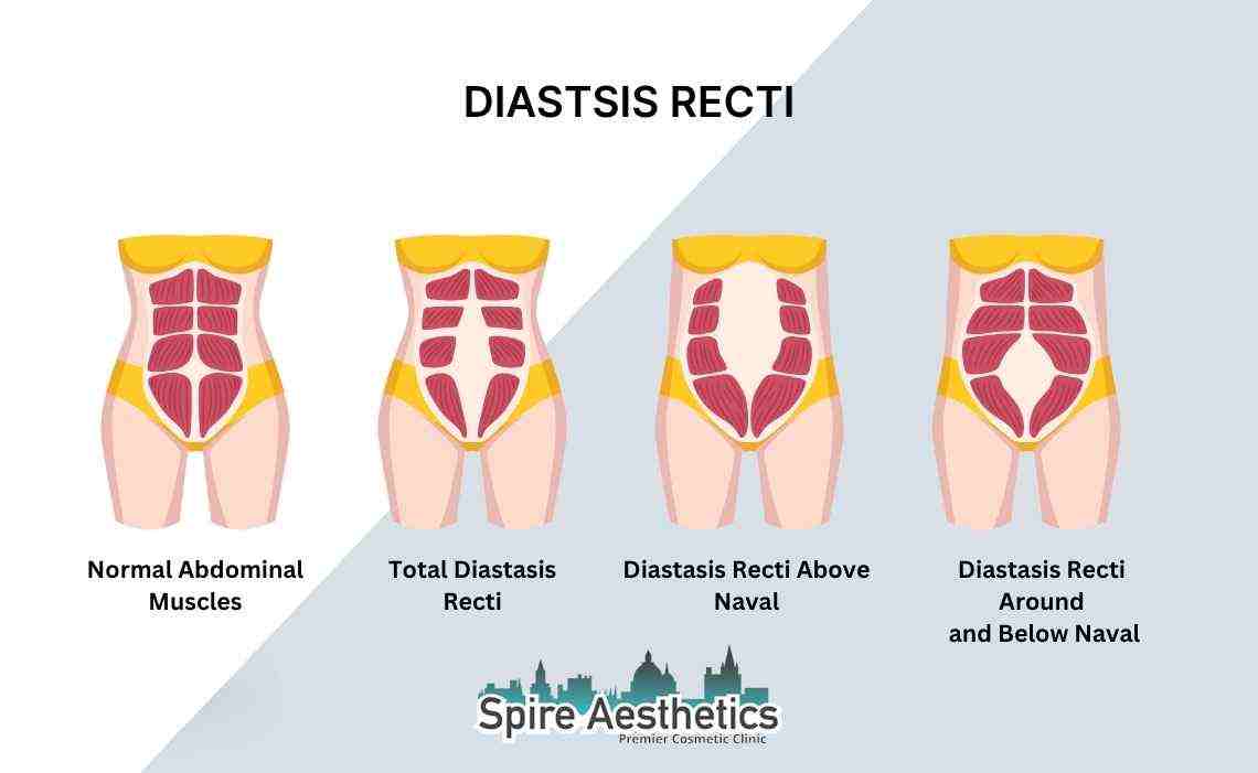Is Non-Surgical Diastasis Recti Treatment Right for You? Common Concerns Answered Hythe